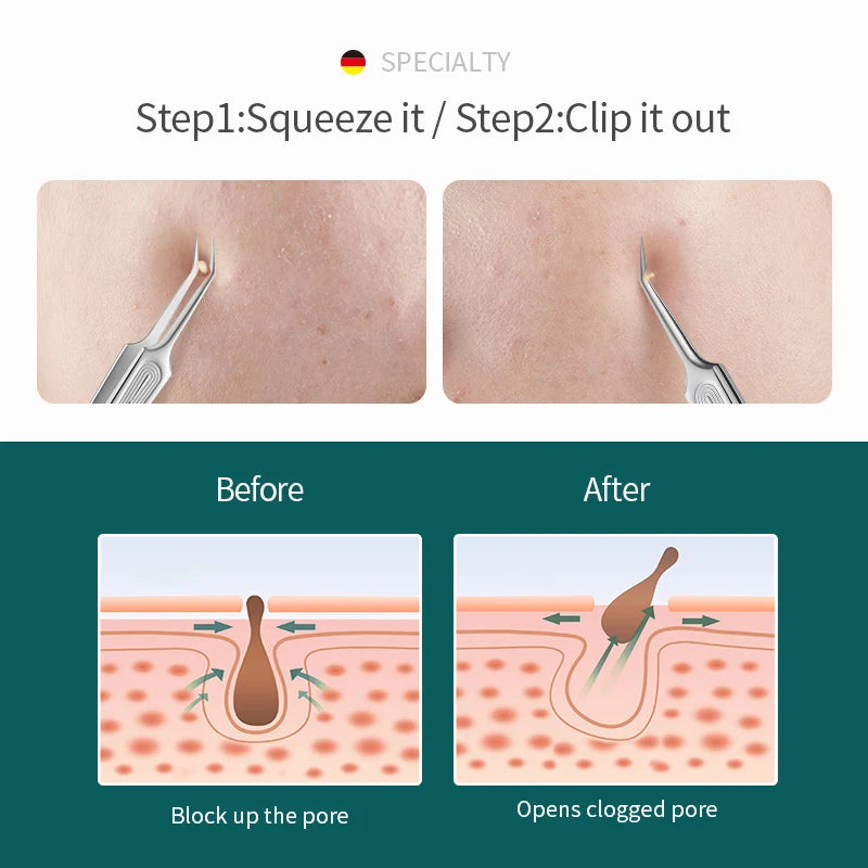MR.GREEN Acne Remover Needles Blackhead Removal Pimple