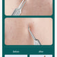 MR.GREEN Acne Remover Needles Blackhead Removal Pimple