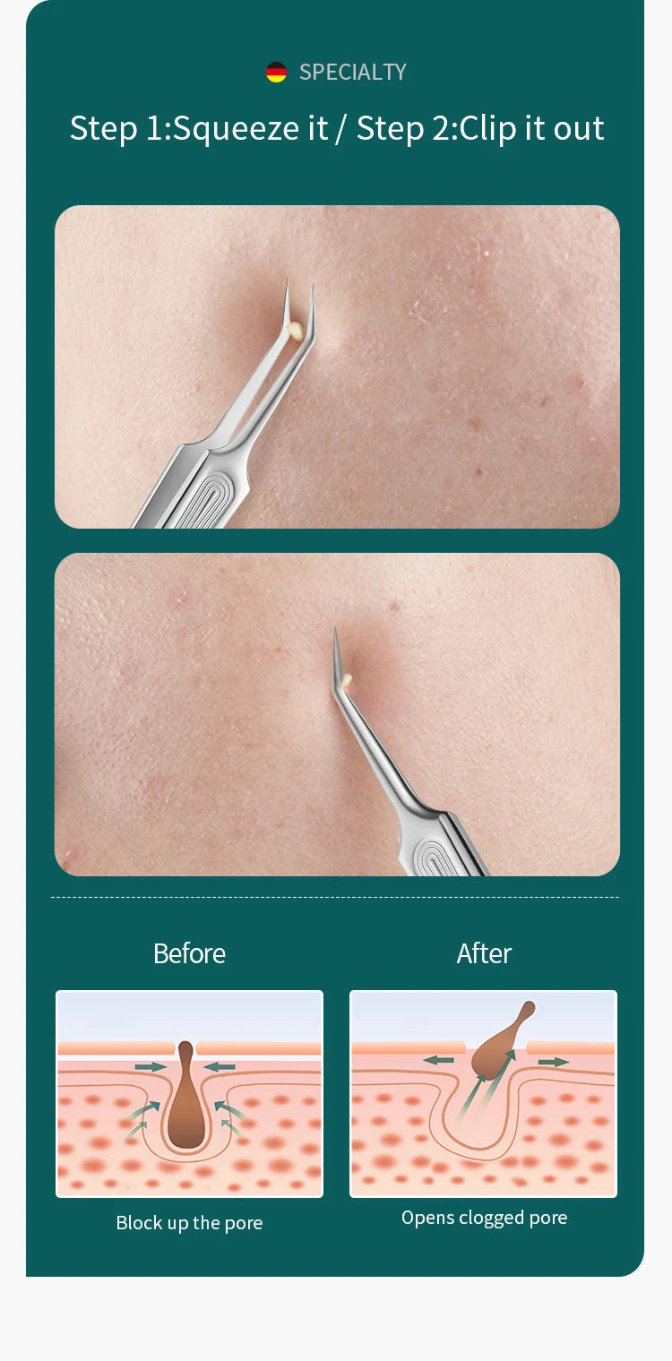 MR.GREEN Acne Remover Needles Blackhead Removal Pimple